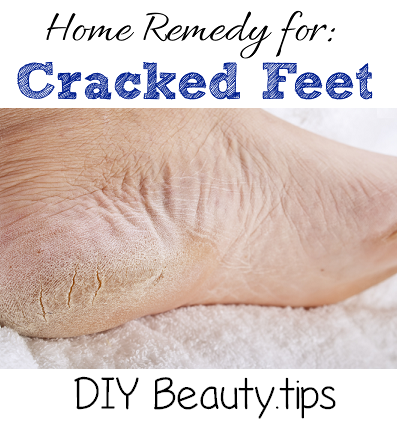 cracked feet remedy